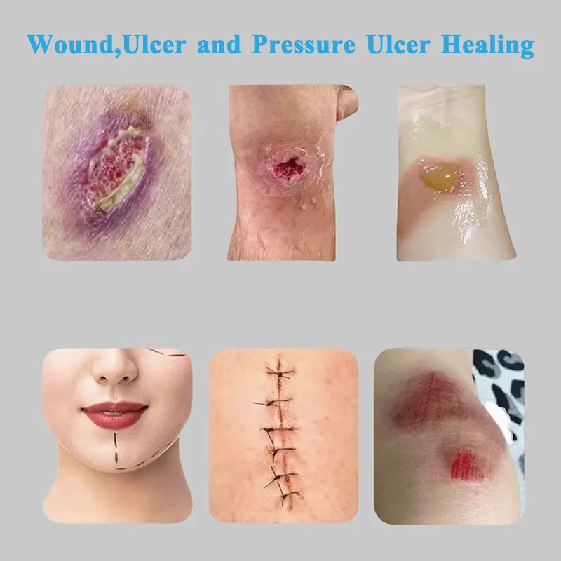 समुद्री शैवाल फाइबर सुई के अनुप्रयोग